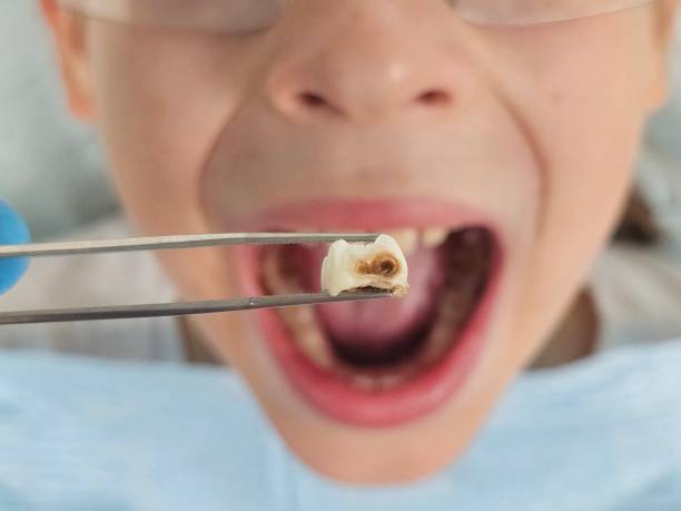 Best Knocked-Out Tooth Emergency  in Casselberry, FL